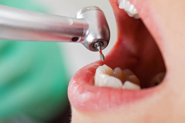 Best Emergency Wisdom Teeth Removal in Groveland, FL